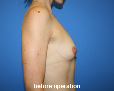 plastic-surgery-breast-augmentation